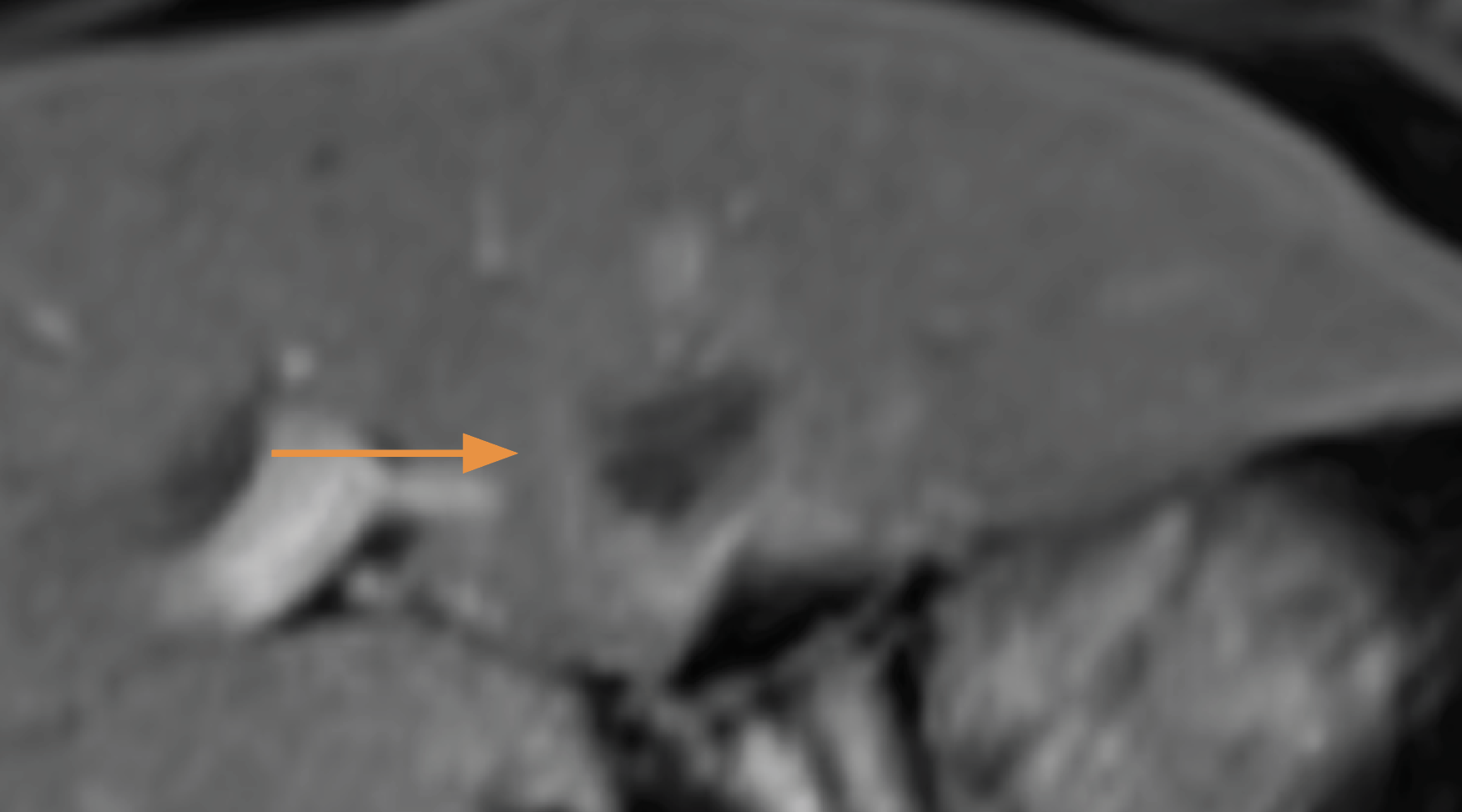 An arrow pointing at a dark spot in a scan