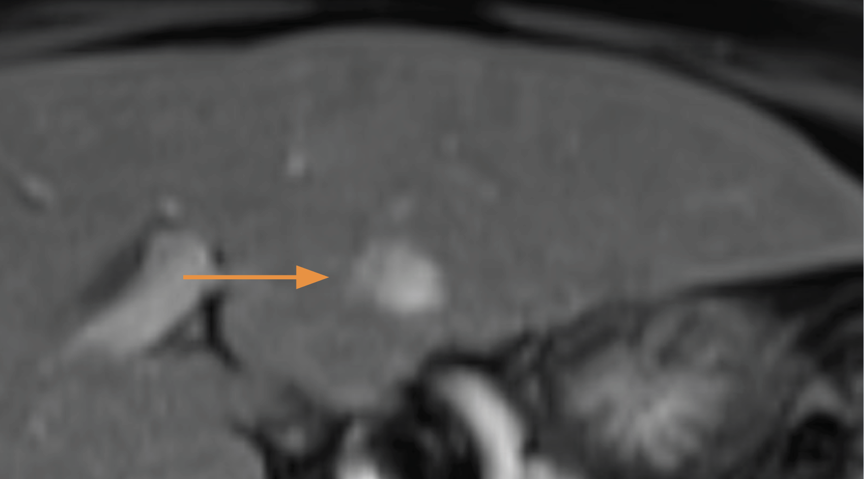 An arrow pointing at a white spot in a scan